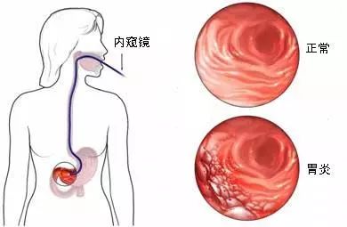 一枚小膠囊，看清你的胃！